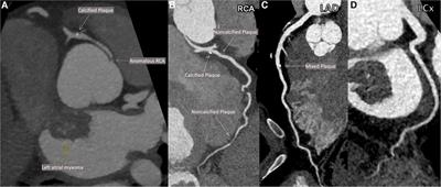 Case report: Coronary atherosclerosis in a patient with long-standing very low LDL-C without lipid-lowering therapy